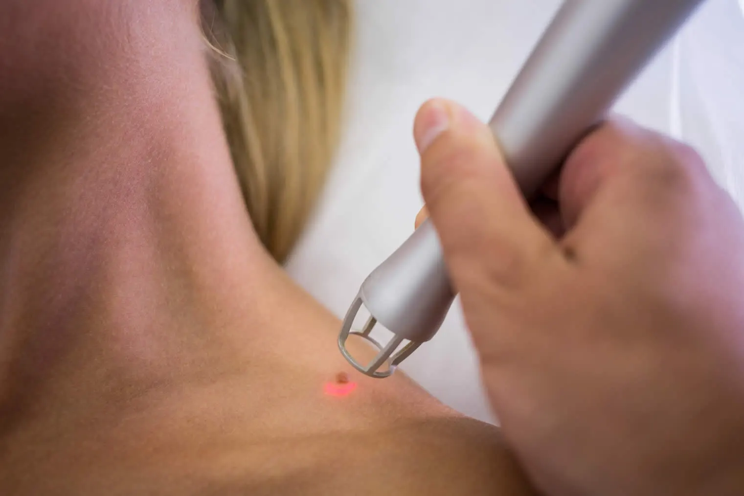 Mole Removal in Riverside Dermatologist Mole Removal