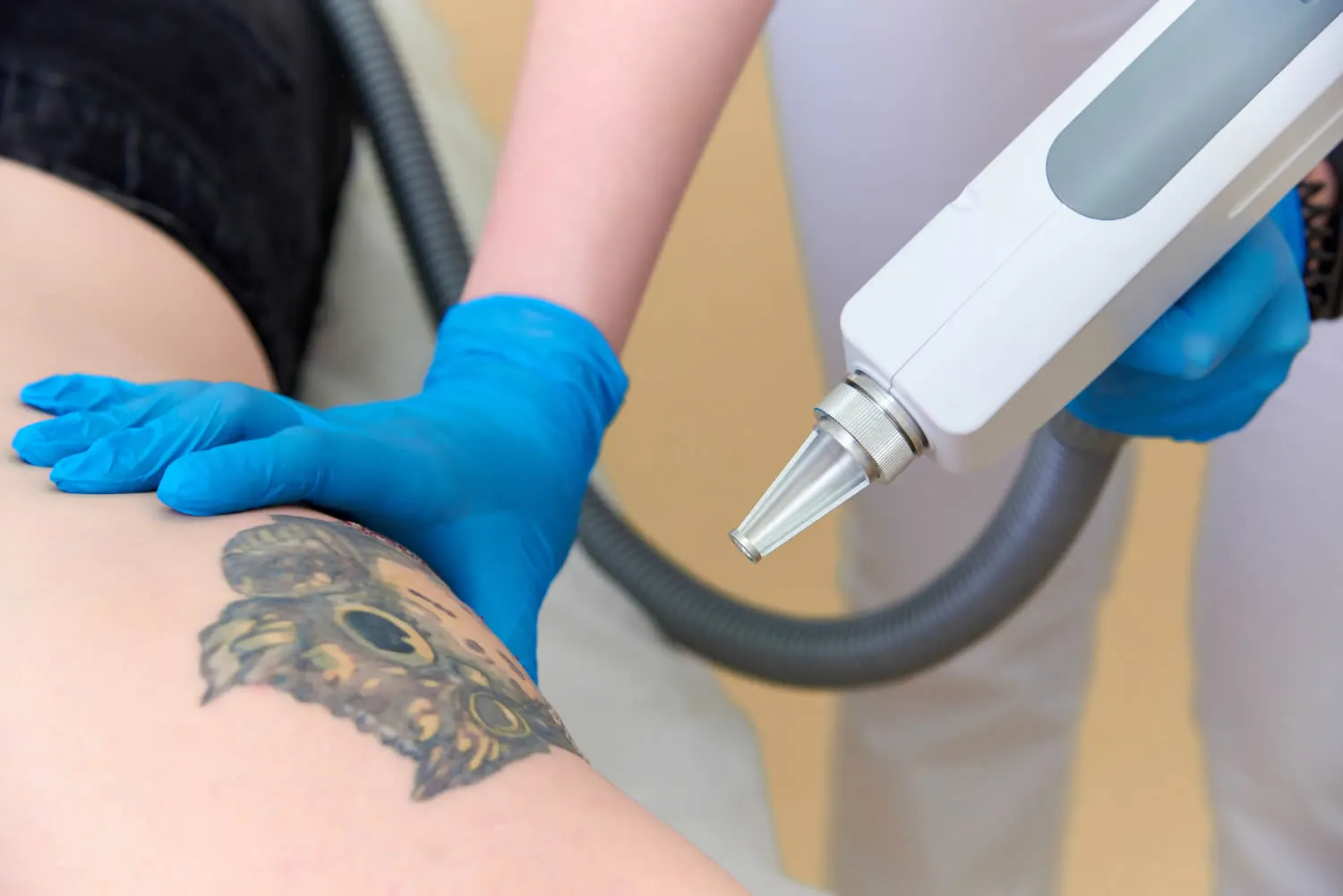 4 Reasons to Consider Laser Treatments for Removing Unwanted Tattoos - Laser  NY